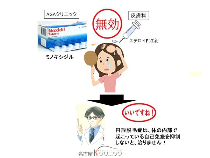 円形脱毛症　病院